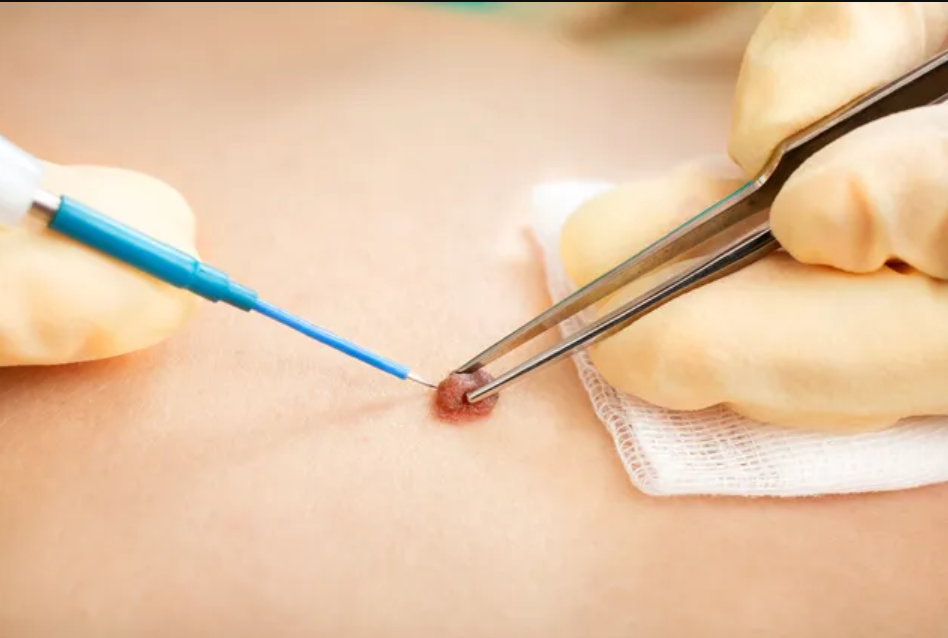 Mole Removal Vadodara